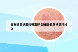 郑州银屑病医院哪家好 郑州治银屑病医院排名