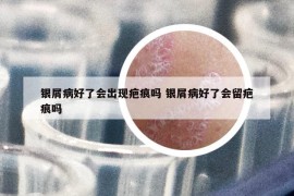 银屑病好了会出现疤痕吗 银屑病好了会留疤痕吗