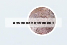 血热型银屑病表现 血热型银屑病特征