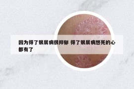 因为得了银屑病很抑郁 得了银屑病想死的心都有了