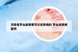 河南省罗山县哪里可以皮肤病的 罗山皮肤病医院