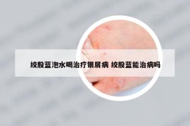 绞股蓝泡水喝治疗银屑病 绞股蓝能治病吗