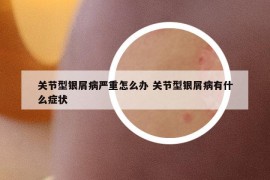 关节型银屑病严重怎么办 关节型银屑病有什么症状