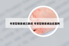 寻常型银屑病三联症 寻常型银屑病治愈案例