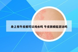 身上有牛皮癣可以戏水吗 牛皮肤癣能游泳吗