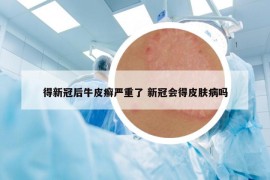 得新冠后牛皮癣严重了 新冠会得皮肤病吗