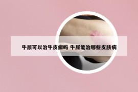 牛尿可以治牛皮癣吗 牛尿能治哪些皮肤病