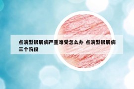 点滴型银屑病严重难受怎么办 点滴型银屑病三个阶段