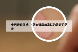 中药治银屑病 中药治银屑病发红的最好的药膏