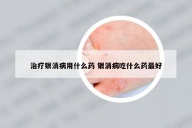 治疗银消病用什么药 银消病吃什么药最好