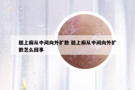 腿上癣从中间向外扩散 腿上癣从中间向外扩散怎么回事