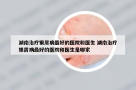 湖南治疗银屑病最好的医院和医生 湖南治疗银屑病最好的医院和医生是哪家