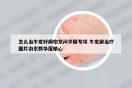 怎么治牛皮好癣南京问华厦专项 牛皮廨治疗图片南京数华厦精心