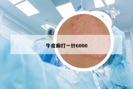 牛皮癣打一针6000