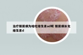 治疗银屑病为啥吃维生素ad呢 银屑病补充维生素d