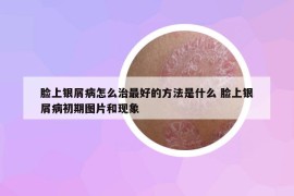 脸上银屑病怎么治最好的方法是什么 脸上银屑病初期图片和现象