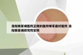 洛阳银屑病医院正规的医院哪家最好医院 洛阳银屑病研究院官网