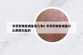 寻常型银屑病复发几率6 寻常型银屑病是什么原因引起的