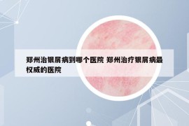 郑州治银屑病到哪个医院 郑州治疗银屑病最权威的医院