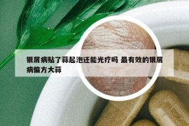 银屑病贴了蒜起泡还能光疗吗 最有效的银屑病偏方大蒜