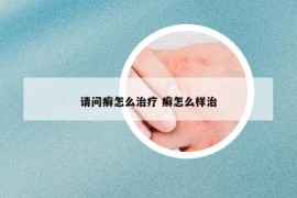 请问癣怎么治疗 癣怎么样治