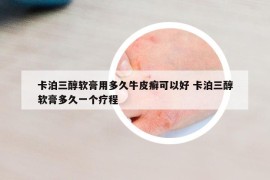 卡泊三醇软膏用多久牛皮癣可以好 卡泊三醇软膏多久一个疗程