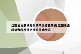 江西省皮肤病专科医院治疗银屑病 江西省皮肤病专科医院治疗银屑病专家