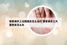 银屑病手上无限褪皮怎么治疗 银屑病手上大量脱皮怎么办