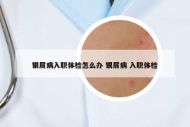 银屑病入职体检怎么办 银屑病 入职体检