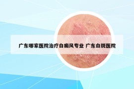 广东哪家医院治疗白癜风专业 广东白斑医院