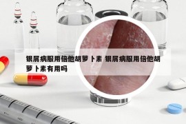 银屑病服用倍他胡萝卜素 银屑病服用倍他胡萝卜素有用吗