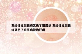 系统性红斑狼疮又患了银屑病 系统性红斑狼疮又患了银屑病能治好吗