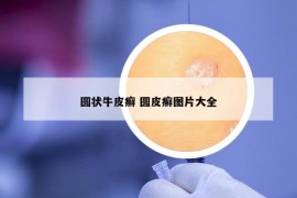 圆状牛皮癣 圆皮癣图片大全