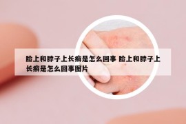 脸上和脖子上长癣是怎么回事 脸上和脖子上长癣是怎么回事图片