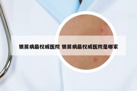 银屑病最权威医院 银屑病最权威医院是哪家