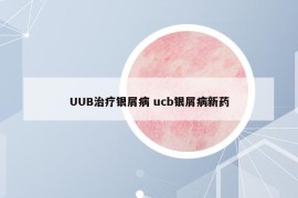 UUB治疗银屑病 ucb银屑病新药