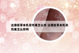 达康臣草本乳膏效果怎么样 达康臣草本乳膏效果怎么样啊