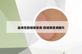 连续性肢端银屑病 肢端银屑病图片