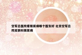 空军总医院看银屑病哪个医生好 北京空军总院皮肤科银屑病