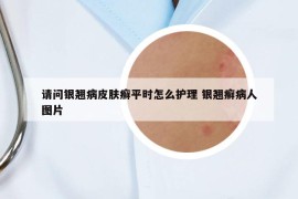 请问银翘病皮肤癣平时怎么护理 银翘癣病人图片