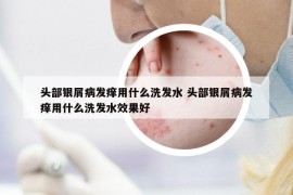 头部银屑病发痒用什么洗发水 头部银屑病发痒用什么洗发水效果好