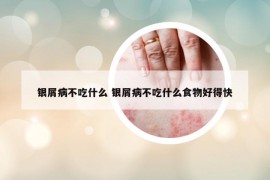 银屑病不吃什么 银屑病不吃什么食物好得快