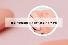 肚子上有皮癣擦什么药好 肚子上长了皮癣