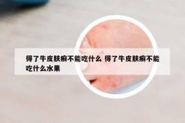 得了牛皮肤癣不能吃什么 得了牛皮肤癣不能吃什么水果