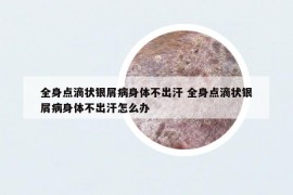 全身点滴状银屑病身体不出汗 全身点滴状银屑病身体不出汗怎么办