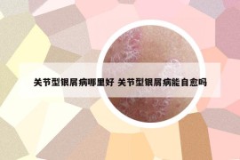 关节型银屑病哪里好 关节型银屑病能自愈吗