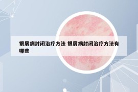 银屑病封闭治疗方法 银屑病封闭治疗方法有哪些