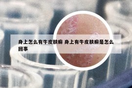 身上怎么有牛皮肤癣 身上有牛皮肤癣是怎么回事