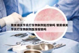 银屑病关节炎打生物制剂能控制吗 银屑病关节炎打生物制剂医保报销吗