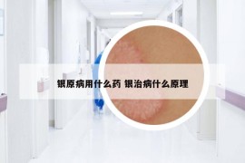 银原病用什么药 银治病什么原理